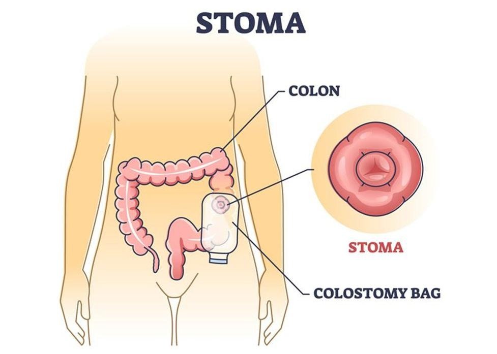 Common Types of Medical Stomas