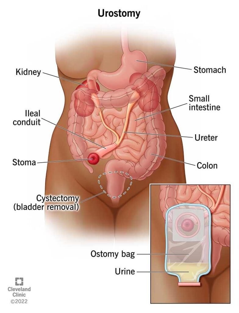 Ileostomy