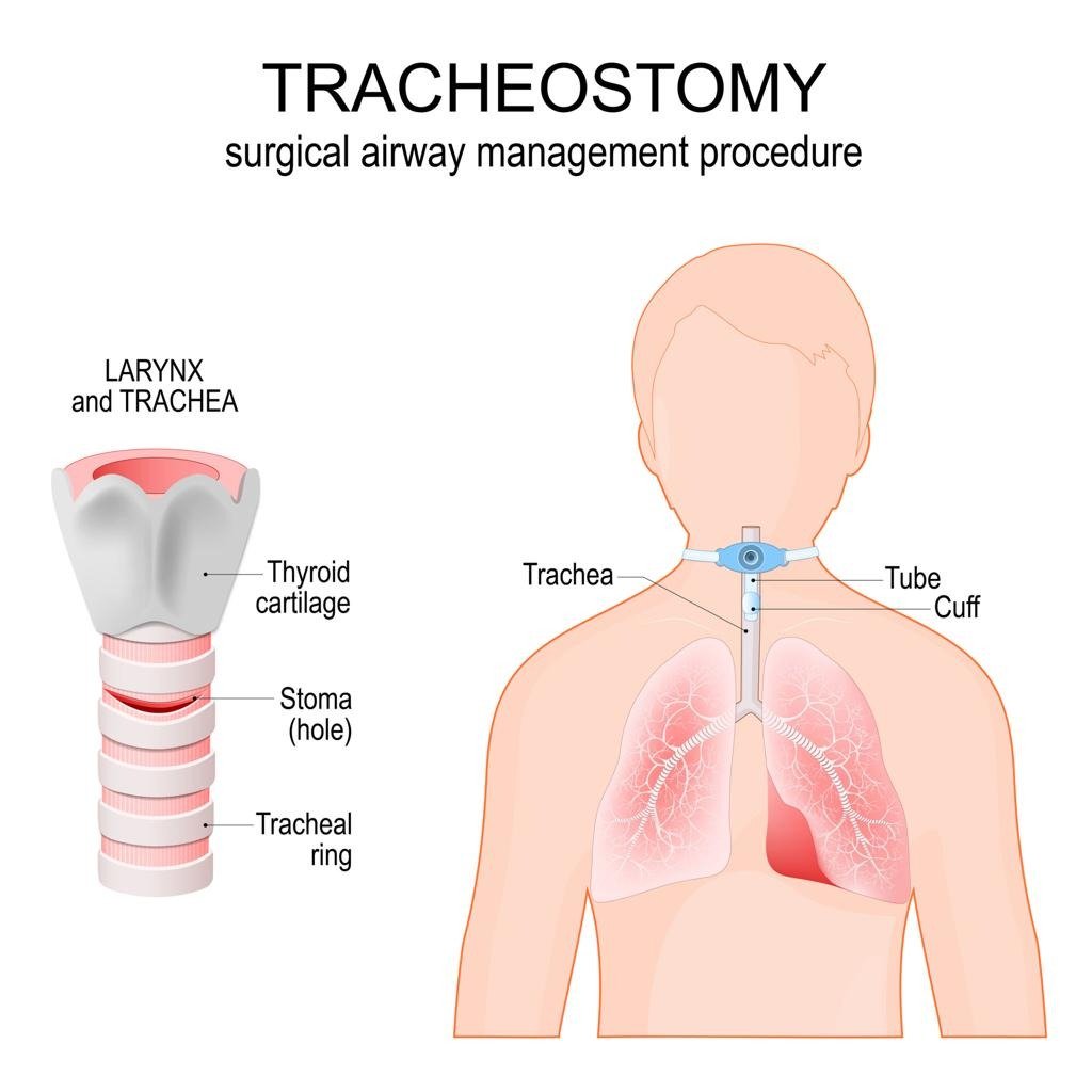 Tracheostomy