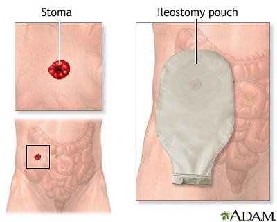 Colostomy